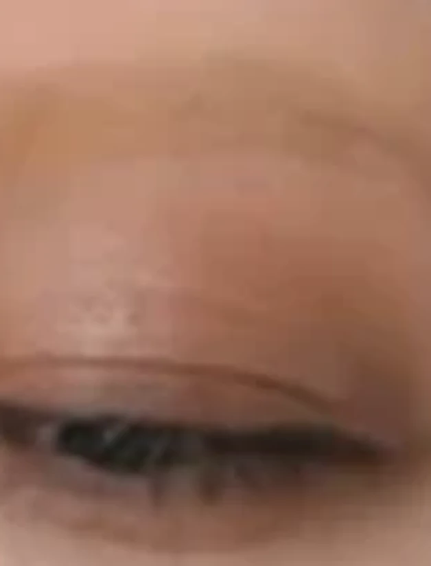 Kết quả trước và sau khi xóa phun xăm — sau khi thực hiện